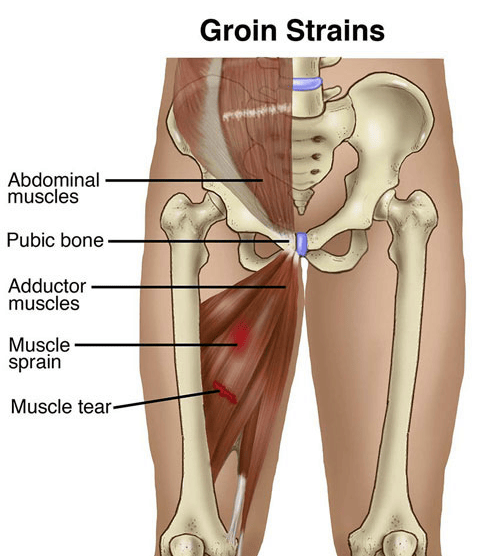 Ouch - The Anatomy of a Groin Pull