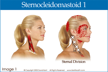 Are You Suffering From Trigger Point Pain?